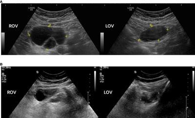 Clinical characteristics and molecular etiology of partial 17α-hydroxylase deficiency diagnosed in 46,XX patients